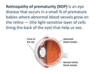 Common eye disease | PPTX