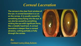 The cornea is the clear front window of
the eye. A corneal laceration is a cut
on the cornea. It is usually caused by
something sharp flying into the eye. It
can also be caused by something
striking the eye with significant force,
like a metallic hand tool. A corneal
laceration is deeper than a corneal
abrasion, cutting partially or fully
through the cornea.
Corneal Laceration
Rx:
Contact Lens,Glue,Suture.
 