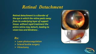 Retinal detachment is a disorder of
the eye in which the retina peels away
from its underlying layer of support
tissue. without rapid treatment the
entire retina may detach, leading to
vision loss and blindness .
IIEI&H
Retinal Detachment
Rx:
 Laser photocoagulation
 Scleral buckle surgery
 Vitrectomy
 