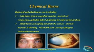 Common eye injury | PPTX