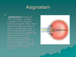 Asigmatism

(distortion) occurs in
10% of babies. In this
condition, the cornea is
football-shaped rather than
spherical, and so reflects
light in a distorted way.
Two perpendicular sets of
light rays focus at different
points on or near the
retina, so the image
perceived by the brain is
warped. Astigmatism can
occur by itself or together
with other refractive
errors.
 