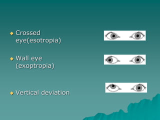 Crossed
eye(esotropia)
 Wall eye
(exoptropia)
 Vertical deviation
 