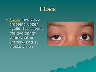 Ptosis
 Ptosis involves a
drooping upper
eyelid that covers
the eye either
somewhat or
entirely, and so
blocks vision.
 
