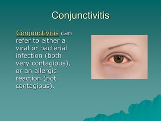 Conjunctivitis
Conjunctivitis can
refer to either a
viral or bacterial
infection (both
very contagious),
or an allergic
reaction (not
contagious).
 