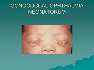 GONOCOCCAL OPHTHALMIA
NEONATORUM
 