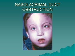 NASOLACRIMAL DUCT
OBSTRUCTION
 