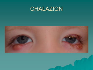 CHALAZION
 