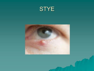 STYE
 