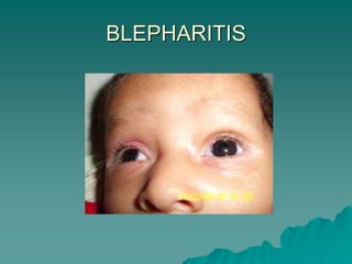 BLEPHARITIS
 
