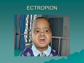 ECTROPION
 