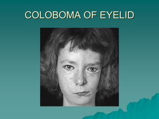 COLOBOMA OF EYELID
 
