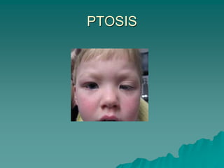 PTOSIS
 