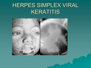 HERPES SIMPLEX VIRAL
KERATITIS
 