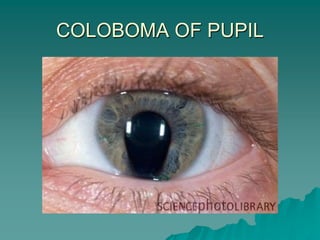 COLOBOMA OF PUPIL
 