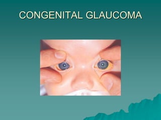 CONGENITAL GLAUCOMA
 