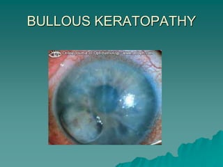 BULLOUS KERATOPATHY
 