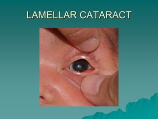 LAMELLAR CATARACT
 