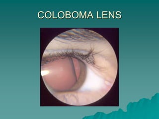 COLOBOMA LENS
 