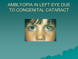 AMBLYOPIA IN LEFT EYE DUE
TO CONGENITAL CATARACT
 