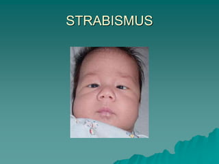 STRABISMUS
 