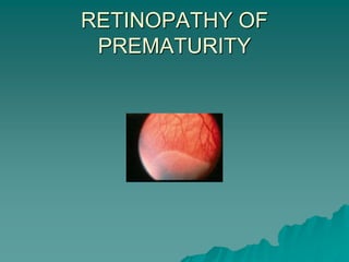 RETINOPATHY OF
PREMATURITY
 