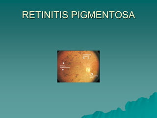 RETINITIS PIGMENTOSA
 