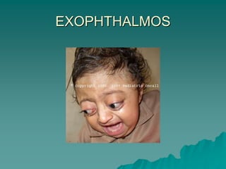 EXOPHTHALMOS
 