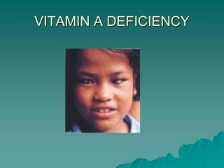 VITAMIN A DEFICIENCY
 