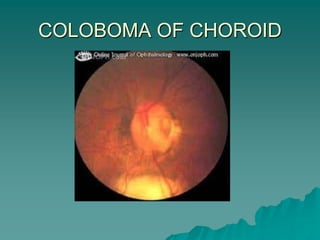 COLOBOMA OF CHOROID
 