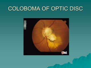 COLOBOMA OF OPTIC DISC
 
