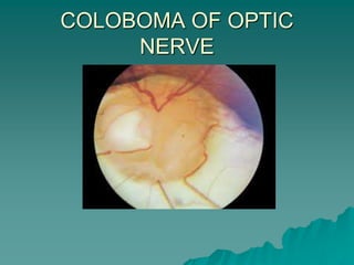 COLOBOMA OF OPTIC
NERVE
 