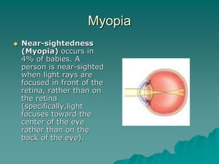 Myopia
 Near-sightedness
(Myopia) occurs in
4% of babies. A
person is near-sighted
when light rays are
focused in front of the
retina, rather than on
the retina
(specifically,light
focuses toward the
center of the eye
rather than on the
back of the eye).
 