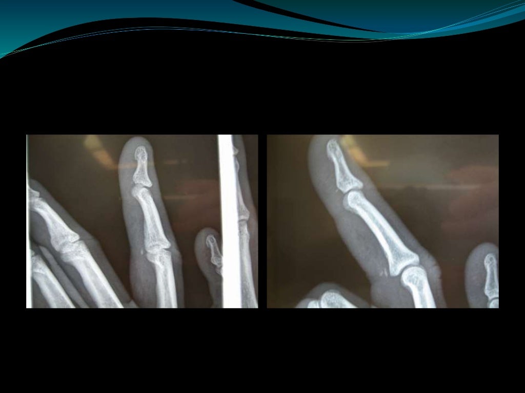 Common fractures svh jmo