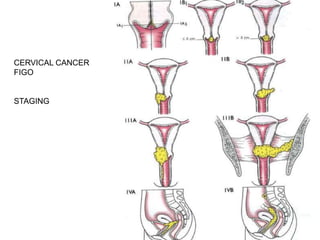 CERVICAL CANCER
FIGO


STAGING
 