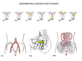 ENDOMETRIAL CANCER FIGO STAGING
 
