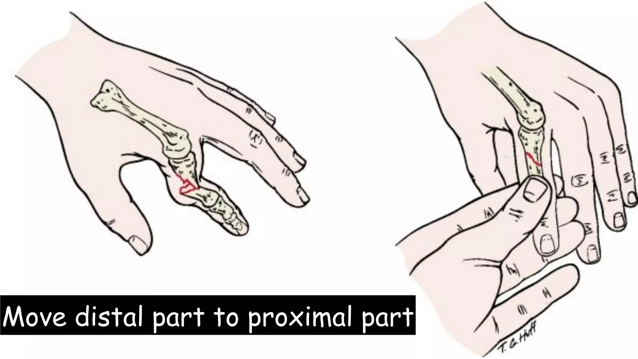 Common Hand Fractures & Dislocations | PDF