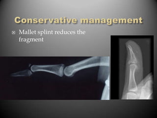    Mallet splint reduces the
    fragment
 