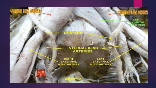 Common illiac artery