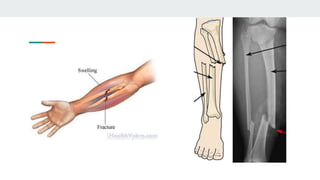 Common Injuries in the Skeletal System