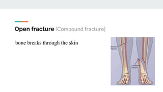 Open fracture (Compound fracture)
bone breaks through the skin
 