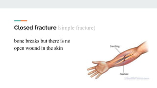 Closed fracture (simple fracture)
bone breaks but there is no
open wound in the skin
 