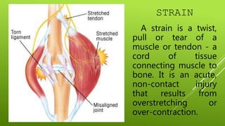 Example Of Strain Injuries COMMON INJURIES INVOLVED IN ACTIVE RECREATIONAL ACTIVITIES.pptx