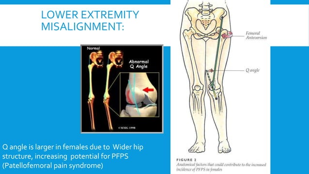 Common injuries of lower extremity | PPTX | Death, Injury, or Military ...