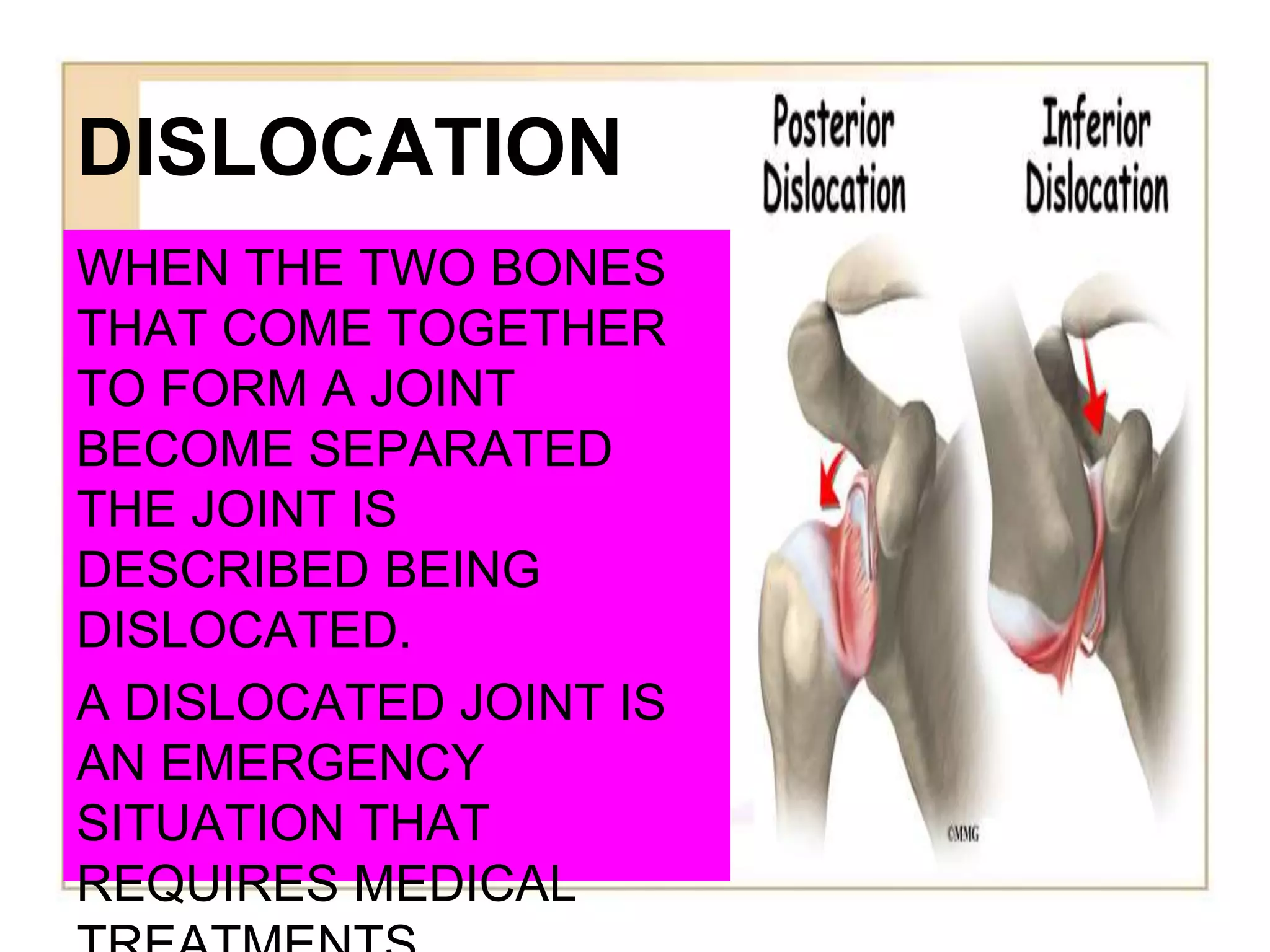 DISLOCATION
WHEN THE TWO BONES
THAT COME TOGETHER
TO FORM A JOINT
BECOME SEPARATED
THE JOINT IS
DESCRIBED BEING
DISLOCATED.
A DISLOCATED JOINT IS
AN EMERGENCY
SITUATION THAT
REQUIRES MEDICAL
 