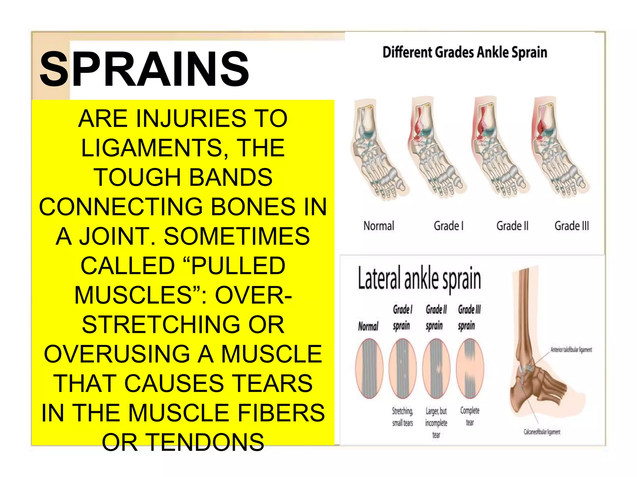 SPRAINS
ARE INJURIES TO
LIGAMENTS, THE
TOUGH BANDS
CONNECTING BONES IN
A JOINT. SOMETIMES
CALLED “PULLED
MUSCLES”: OVER-
STRETCHING OR
OVERUSING A MUSCLE
THAT CAUSES TEARS
IN THE MUSCLE FIBERS
OR TENDONS
 