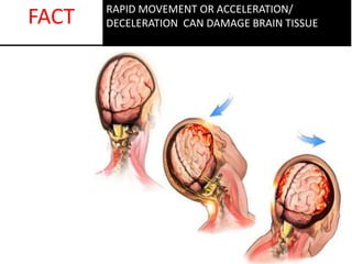 RAPID MOVEMENT OR ACCELERATION/
DECELERATION CAN DAMAGE BRAIN TISSUEFACT
 