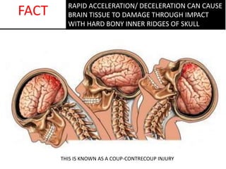 RAPID ACCELERATION/ DECELERATION CAN CAUSE
BRAIN TISSUE TO DAMAGE THROUGH IMPACT
WITH HARD BONY INNER RIDGES OF SKULL
FACT
THIS IS KNOWN AS A COUP-CONTRECOUP INJURY
 