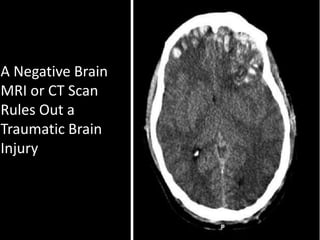 A Negative Brain
MRI or CT Scan
Rules Out a
Traumatic Brain
Injury
 