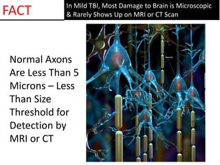 In Mild TBI, Most Damage to Brain is Microscopic
& Rarely Shows Up on MRI or CT ScanFACT
Normal Axons
Are Less Than 5
Microns – Less
Than Size
Threshold for
Detection by
MRI or CT
 