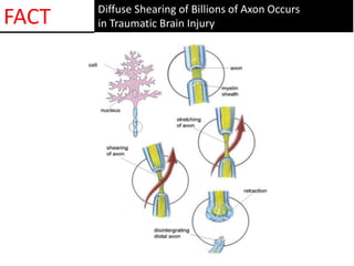 Diffuse Shearing of Billions of Axon Occurs
in Traumatic Brain InjuryFACT
 
